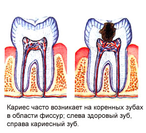 Реферат кариес зубов у детей и его лечение